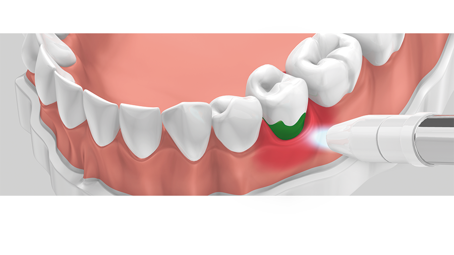 Emundo®-Therapie : 3. Laserenergie aktiviert den Farbstoff durch das Zahnfleisch – Bakterien sterben ab
