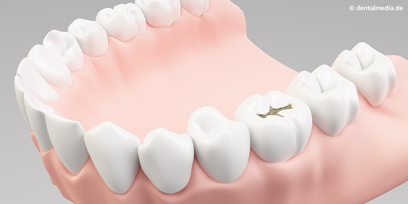 Keramische Inlays : Durch Karies geschädigter Zahn